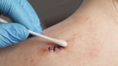Yakın plan, tıbbi steril eldivenli bir doktor genç bir kızın omzunda antiseptik kanama yarasıyla tedavi edilmiş pamuk çubuğu.