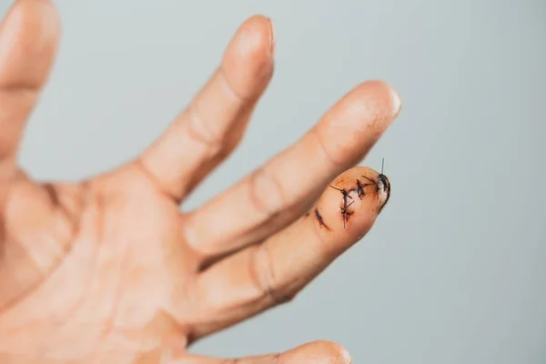 Close Van Hand Van Man Met Hechtwond Aan Vinger Gewond — Stockfoto