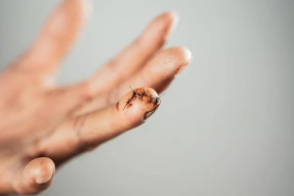 Close Man Hand Sutured Wound Finger Injured Helth Medical Concept — Stock Photo, Image