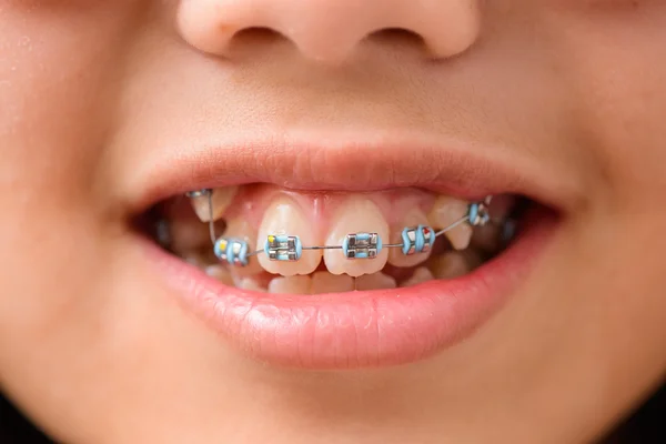 Teeth with braces — Stock Photo, Image