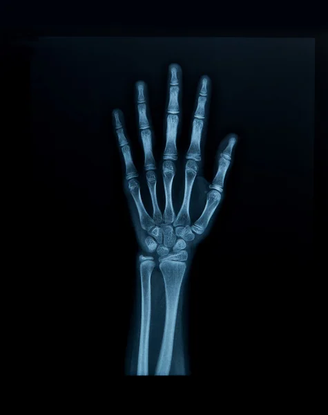 X-ray hand — Stock Photo, Image