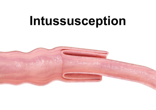 Intussusception is a disorder that causes obstruction of the intestine with serious consequences. 3D rendering