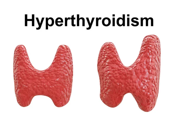 Hipertiroidizm Salgı Bezinin Anormal Bir Şekilde Genişlemesiyle Karakterize Edilir Çeşitli — Stok fotoğraf