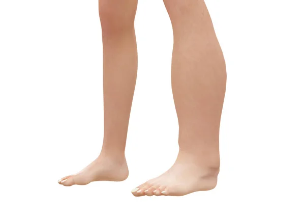 外周水肿是指由于积液而使腿 脚和脚踝肿胀 3D渲染 — 图库照片