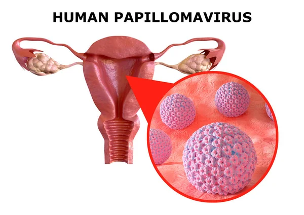 Humane Papillomviren Oder Hpv Sind Eine Sexuell Übertragbare Infektion Verursacht — Stockfoto