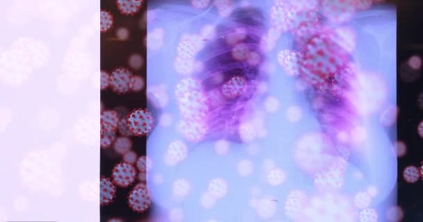 Radiografia Pulmonar Afetada Pelo Coronavírus Raio Mostrando Doença Covid Deixando — Vídeo de Stock