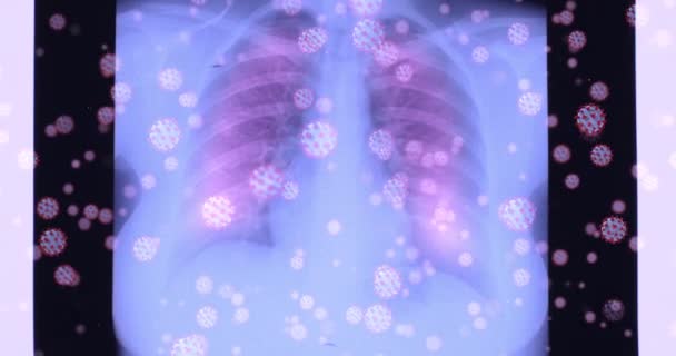 Lungröntgen Påverkas Coronavirus Röntgen Visar Att Sjukdomen Covid Gör Lungorna — Stockvideo