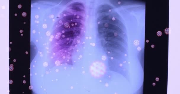 Mano Del Doctor Mostrando Radiografía Pulmonar Afectada Por Coronavirus Radiografía — Vídeos de Stock
