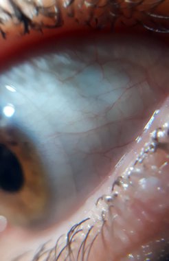 Bilgisayarda çalıştıktan sonraki kızgınlık. Kırmızı göz konjonktiviti. Göz hastalığı sorunu. Kontak lens enfeksiyonu. Göz alerjisi