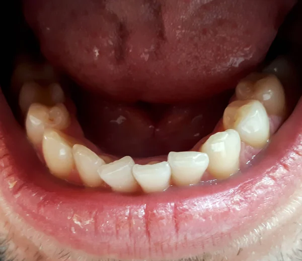 Кривые Зубы Нижней Челюсти Скопление Зубов Передней Части Тесные Резцы — стоковое фото