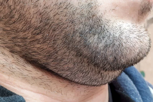 Doppio Mento Uomo Maturo Prima Dell Intervento Chirurgia Plastica Barba — Foto Stock