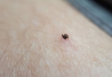 İnsan derisine kene saplanmış. Lyme hastalığı. Kapatma makro kenesi.