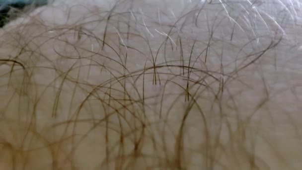 Macro Piel Peluda Humana Concepto Dermatológico Crecimiento Excesivo Del Cabello — Vídeos de Stock