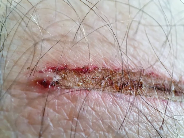 Close Painful Wound Macro Wound Human Skin — Stock Photo, Image