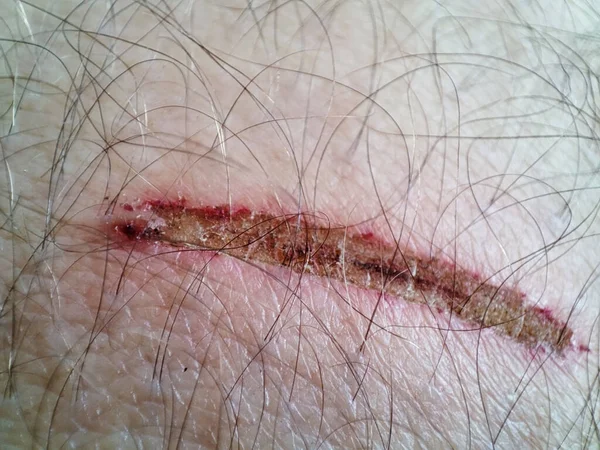 痛みを伴う傷を閉じる 人間の皮膚のマクロ創傷 — ストック写真