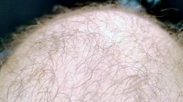 Macro Pele Peluda Humana Conceito Dermatologia Crescimento Excessivo Cabelo — Vídeo de Stock