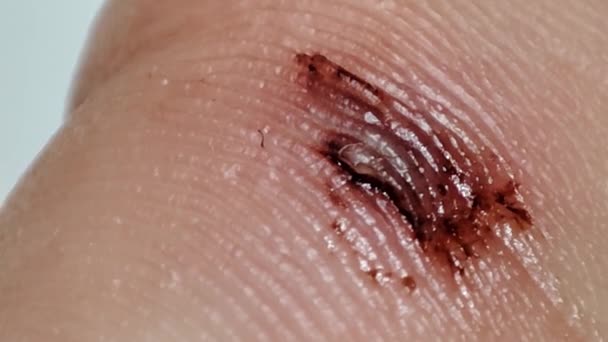 Wunde Kratzer Finger Hintergrund Makroblut — Stockvideo