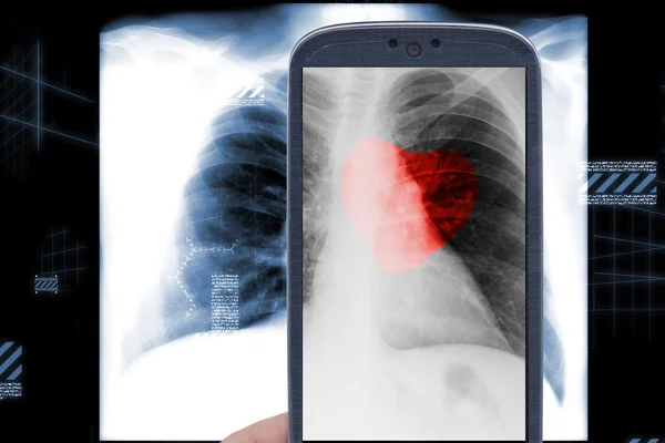 Smartphone rayos X del corazón — Foto de Stock