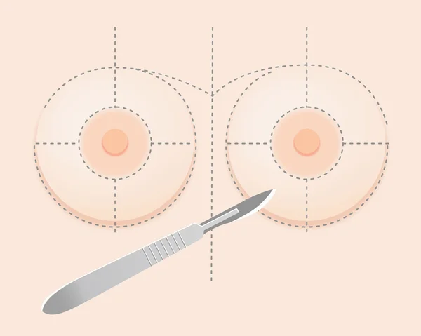 硅胶乳房假体与聚光灯 — 图库矢量图片