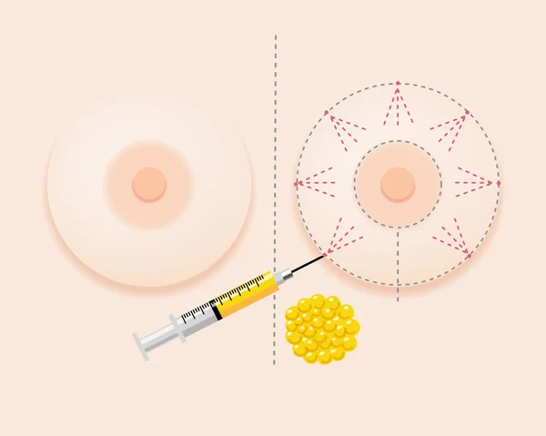 Cirugía de subvención de grasa mamaria con vista frontal Ilustración de stock