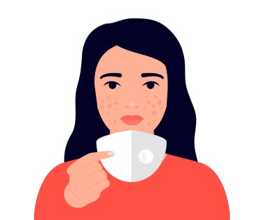 Maskne kadın yüzü konsepti. Yüz koruyucu maske takmanın sonucu sivilcedir. Sivilce, iltihap derisi, leke, alerji. Vektör illüstrasyonu