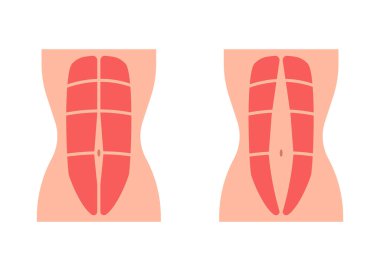 Karın kasları ve diastasis rektti, zayıf ve diverjanslı karın kası. Rektüs abdominal diastazis. Vektör düz resimleme