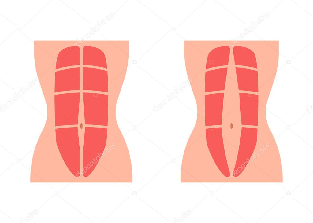 Normal tone muscle abdomen and diastasis recti, weak and divergence abdomen muscle. Rectus abdominal diastasis. Vector flat illustration