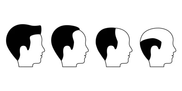Mannelijk Stadium Van Kaalheid Alopecia Haaruitval Bij Mannen Haaruitval Vector — Stockvector