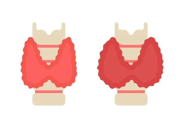 La ghiandola tiroidea sana e malata è aumentata. Controlla la salute dell'organo tiroideo. Ipotiroidismo, dolore, concetto di ceppo. Illustrazione piatta vettoriale — Vettoriale Stock