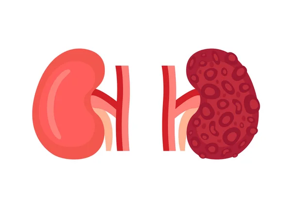 Friska njure och ohälsosam sjukdom njure med polycystisk. Kontrollera njurorganens hälsa. Inre organ njure. Vektorillustration — Stock vektor