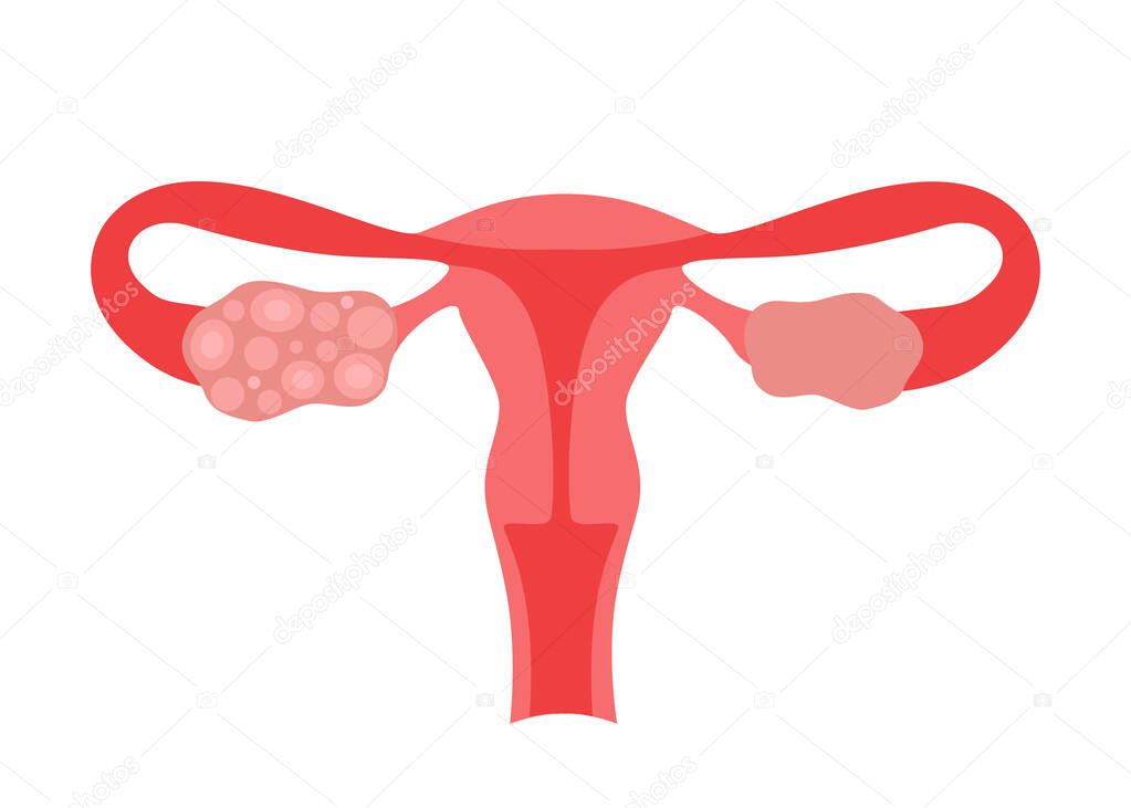 Polycystic ovary syndrome PCOS of woman. Female reproductive system disease. Abnormal uterus internal organ. Vector