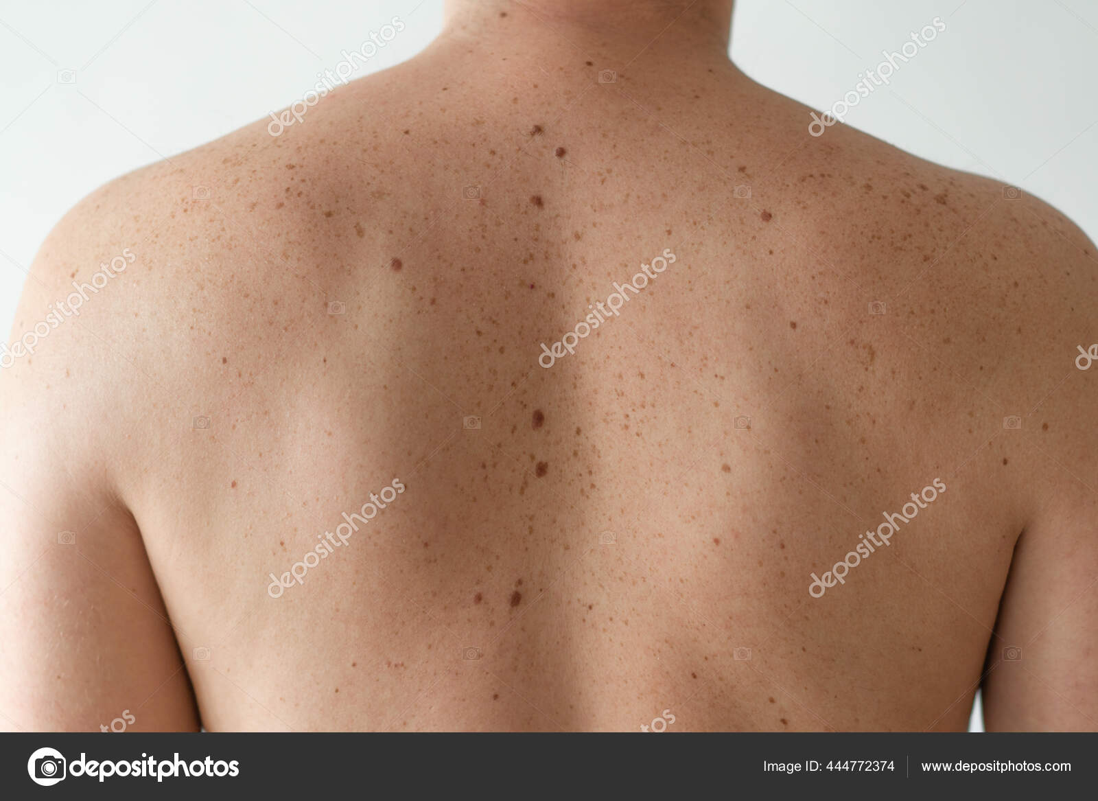 良性のモルをチェックします 散乱したモルとそばかすで男の背中に裸の皮膚の詳細を閉じます 色素沈着 肌の誕生日 ストック写真 C Nastyaofly