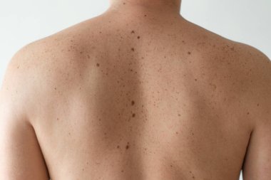 İyi huylu köstebekleri kontrol ediyorum. Sırtında benleri ve çilleri olan bir adamın çıplak derisinin detaylarını kapat. Pigmentasyon. Deride doğum lekeleri