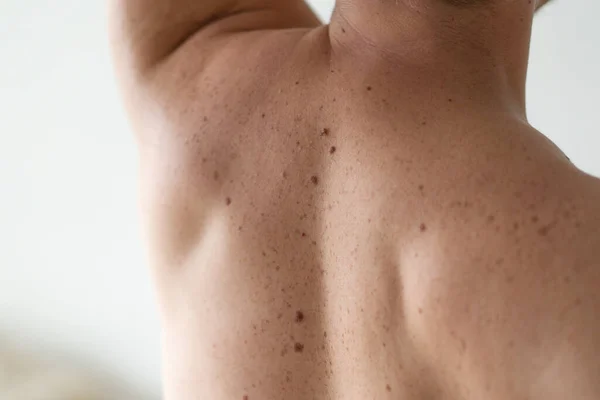 Checking benign moles. Close up detail of the bare skin on a man back with scattered moles and freckles. Pigmentation. Birthmarks on skin