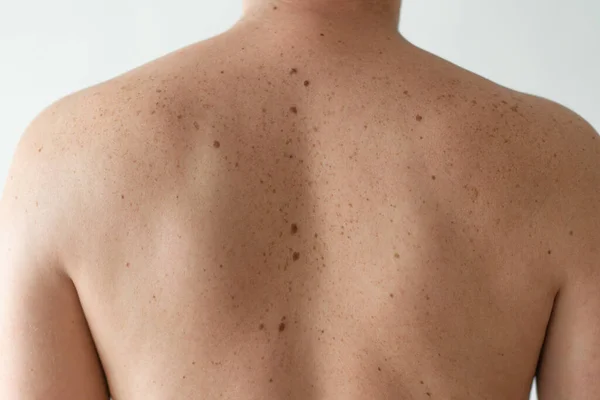 Checking Benign Moles Close Detail Bare Skin Man Back Scattered — Stock Photo, Image