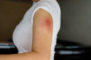 Kovid korona virüsü aşısından sonra kadının koluna aşı tepkisi. Şişmiş kısım, kırmızı delik. Tanınmayan kişi.