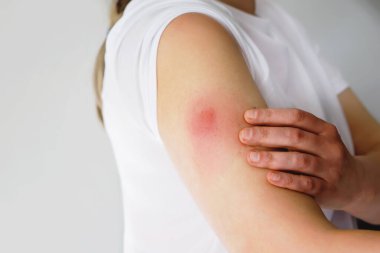 Vaccination reaction on arm of woman after injection of covid corona virus vaccine. Swollen part, red puncture site. Unrecognizable person. clipart