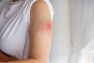 Kovid korona virüsü aşısından sonra kadının koluna aşı tepkisi. Şişmiş kısım, kırmızı delik. Tanınmayan kişi.