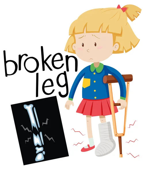Meisje met gebroken been en x-ray film — Stockvector