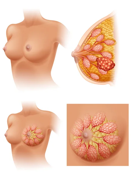 Diagramm einer an Brustkrebs erkrankten Frau — Stockvektor