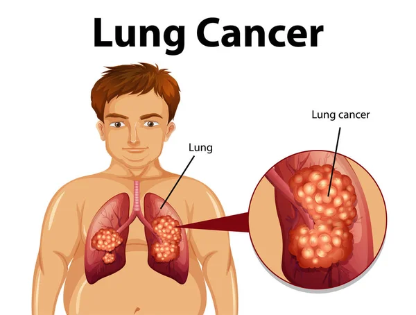 Informative Illustration Von Lungenkrebs — Stockvektor