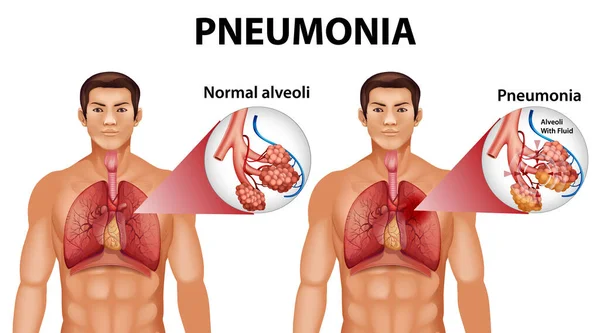 Anatomia Humana Mostrando Pneumonia Ilustração — Vetor de Stock