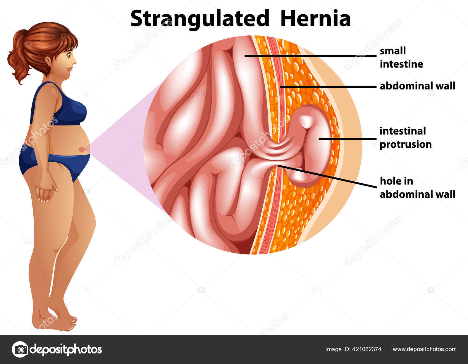 42 Colostomia-stockillustrasjoner | DepositPhotos, image size:1600x1245