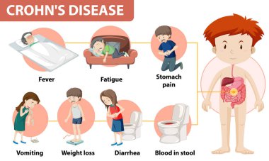Crohn 'un Hastalık İllüstrasyonunun Tıbbi Bilgileri