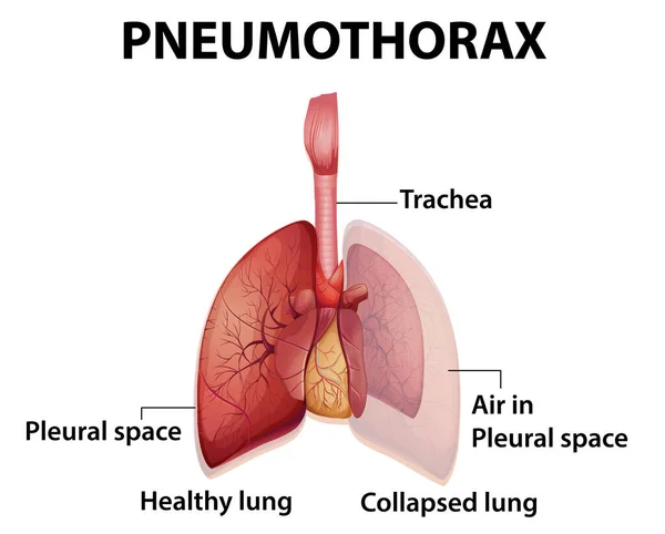 Informativ Illustration Pneumothorax Illustration — Stock vektor