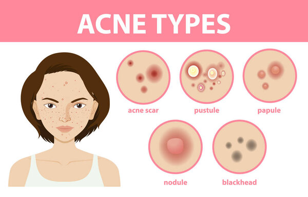 Types of acne on the skin or pimples illustration