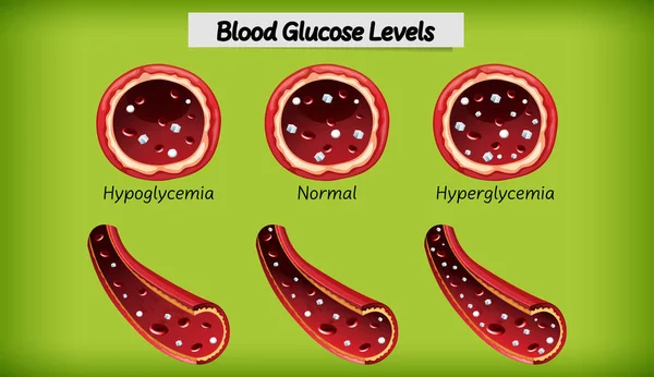 Иллюстрация Уровня Глюкозы Крови — стоковый вектор