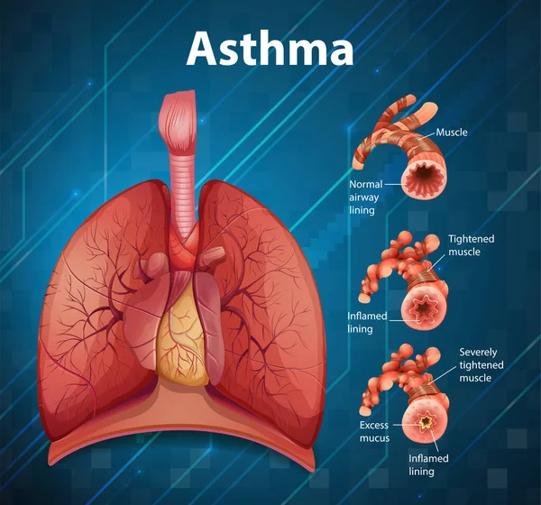 Porównanie Zdrowych Płuc Astmatycznej Ilustracji Płuc — Wektor stockowy