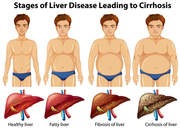 Этапы Заболеваний Печени Приводящие Циррозу — стоковый вектор