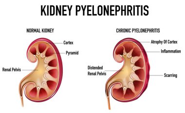Pyelonefrit illüstrasyonunun bilgilendirici illüstrasyonu